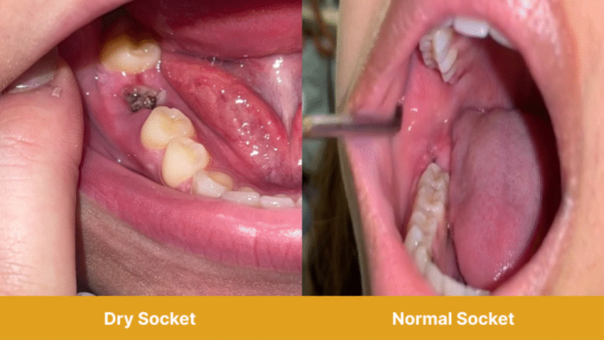 Dry Socket vs Normal